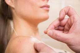 shoulder dry needling
