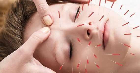 acupuncture pain-relief