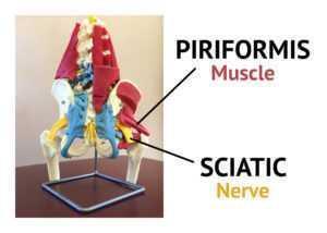 sciatica from piriformis spasm