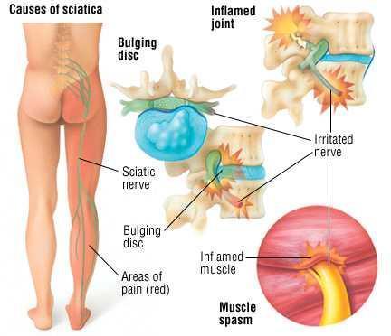 Causes of sciatica nerve pain