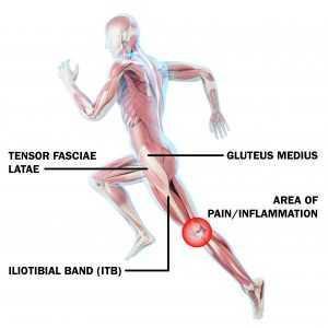 iliotibial band syndrome for runners
