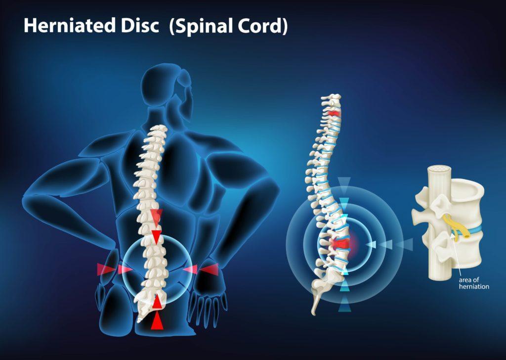 Herniated_Disc_Treatment
