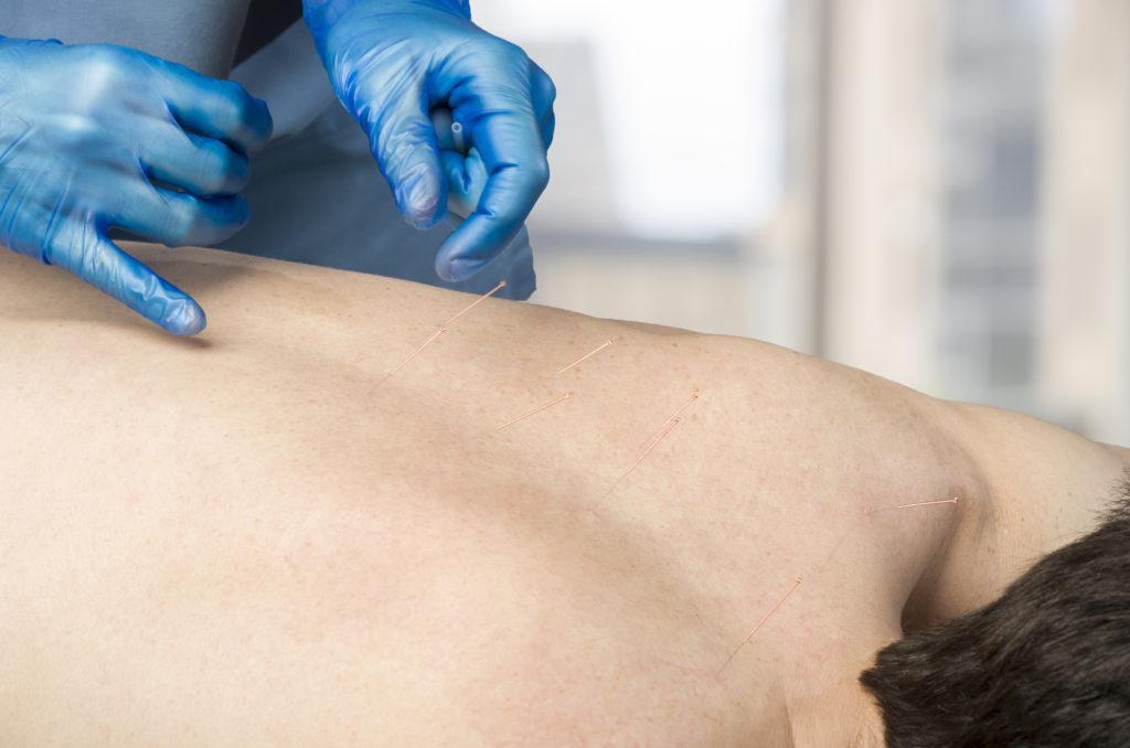 Dry Needling Vs Acupuncture